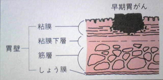 早期胃ガン