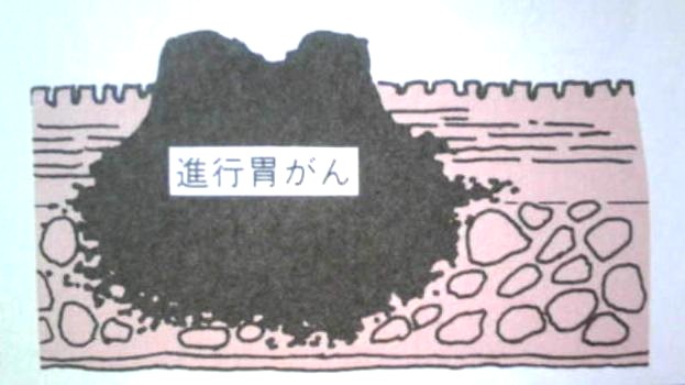 進行胃ガン